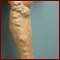 Varicose Vein